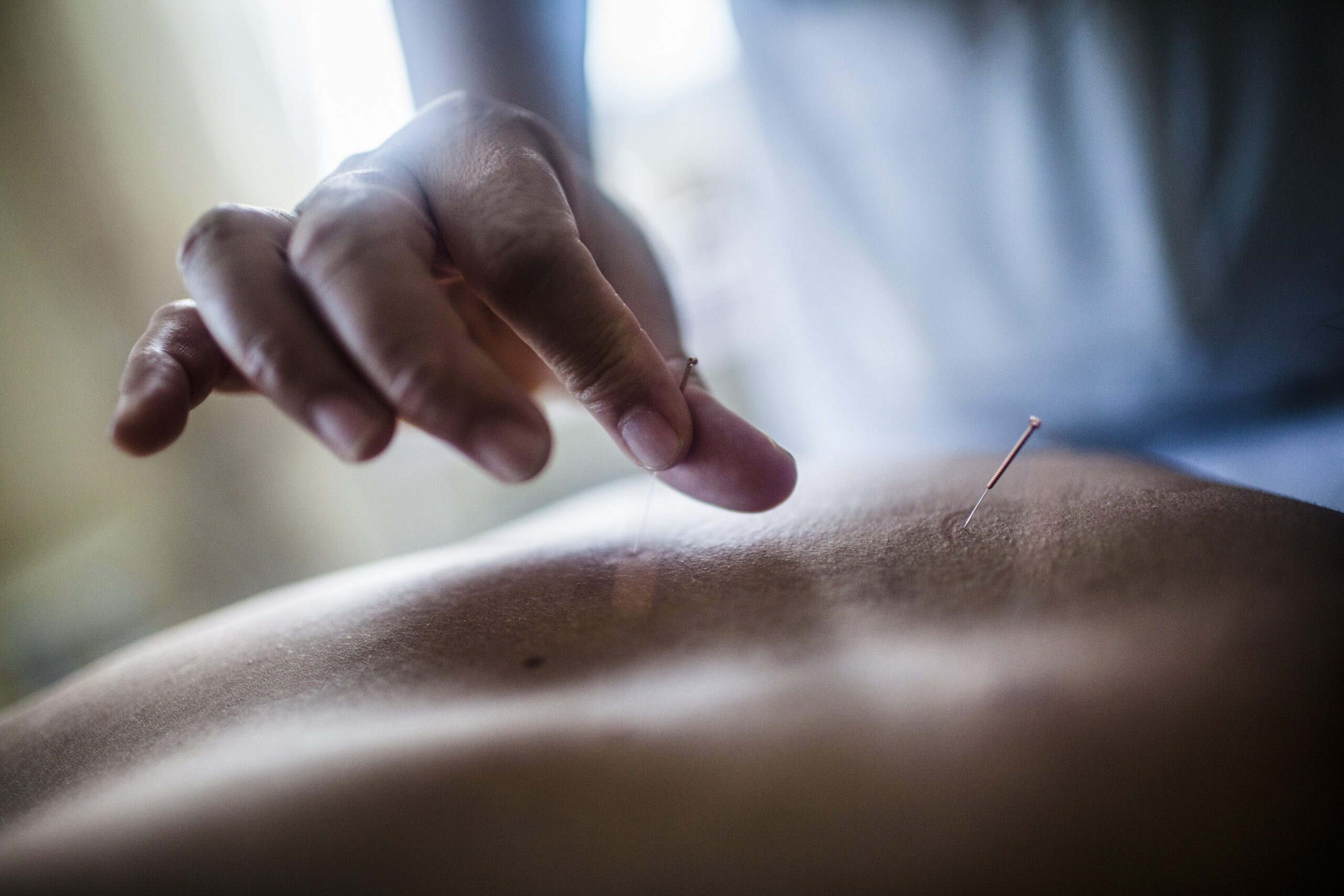 Terapia de Acupuntura en Medellín
